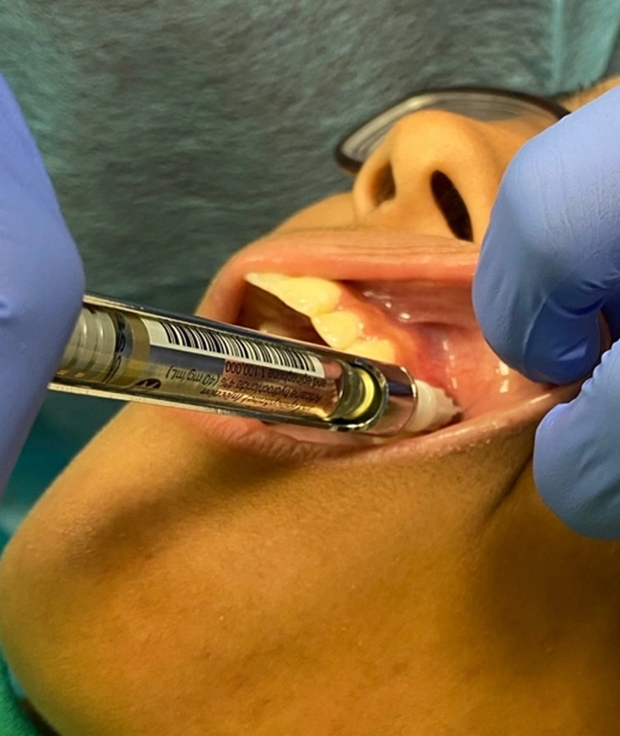 anesthetization of the Maxillary Primary Molars and Premolars