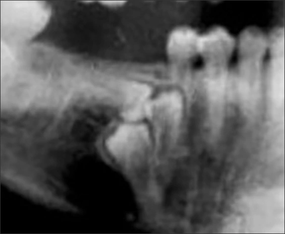 Alterations in the Number of Teeth - Figure 6
