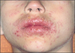 Image: Varicella (chickenpox)