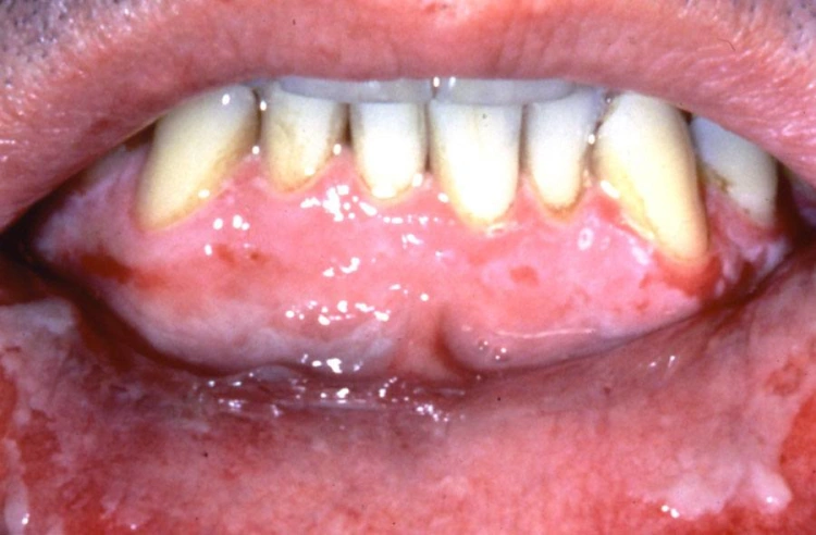 ADRs Affecting Oral Tissues - Adverse Drug Reactions - Part I - Dentalcare