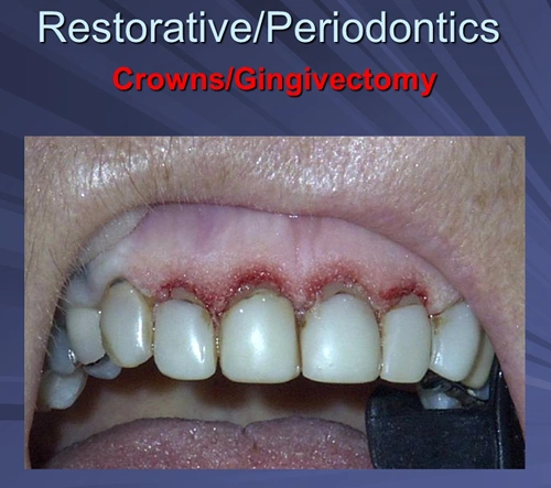 This image depicts immediate post Er,Cr:YSGG gingivectomy and gingivoplasty just prior to crown preparation at the same appointment.