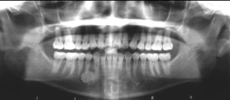 Figure 10. Panoramic Image of a Dense Bone Island.