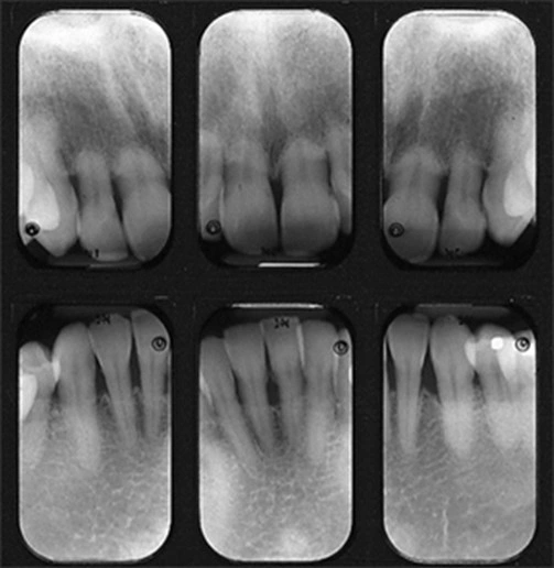 Resorptive Processes - Anomalies of Tooth Structure - Dentalcare
