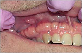 ce337 - Content - Attached Gingiva - Figure 3