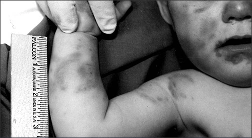 Photo showing multiple injuries on child abuse victim