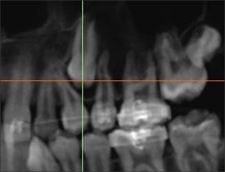 Transposition - Anomalies of Tooth Structure - Dentalcare