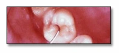 Photo showing an advanced tooth lesion.