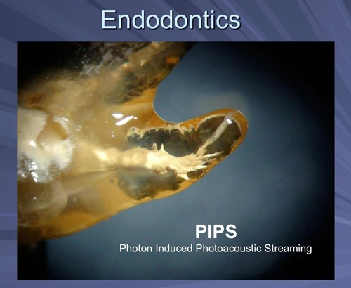 This image depicts a molar that was treated with PIPS only with no mechanical instrumentation and then sealed with EndoRez to demonstrate the effectiveness of the procedure.