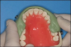 Use of a reduction guide is particularly important when teeth are misaligned.