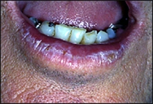 White/gray opalescent plaques of the vermilion - biopsy proven severe dysplasia