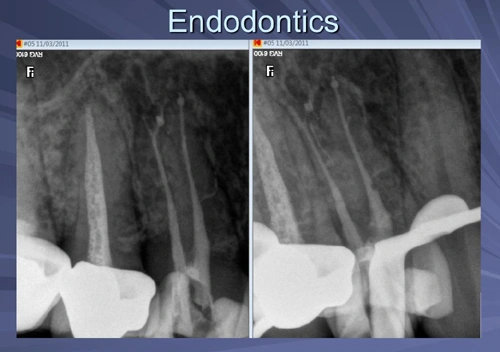 Endodontic Applications | Lasers in Dentistry: Minimally Invasive ...