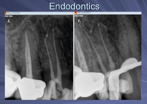 This image depicts tooth 5 instrumented to a size 25 hand file and treated with the PIPS (Photon Induced Photoacoustic Streaming) using sodium hypochlorite, sterile water and EDTA.