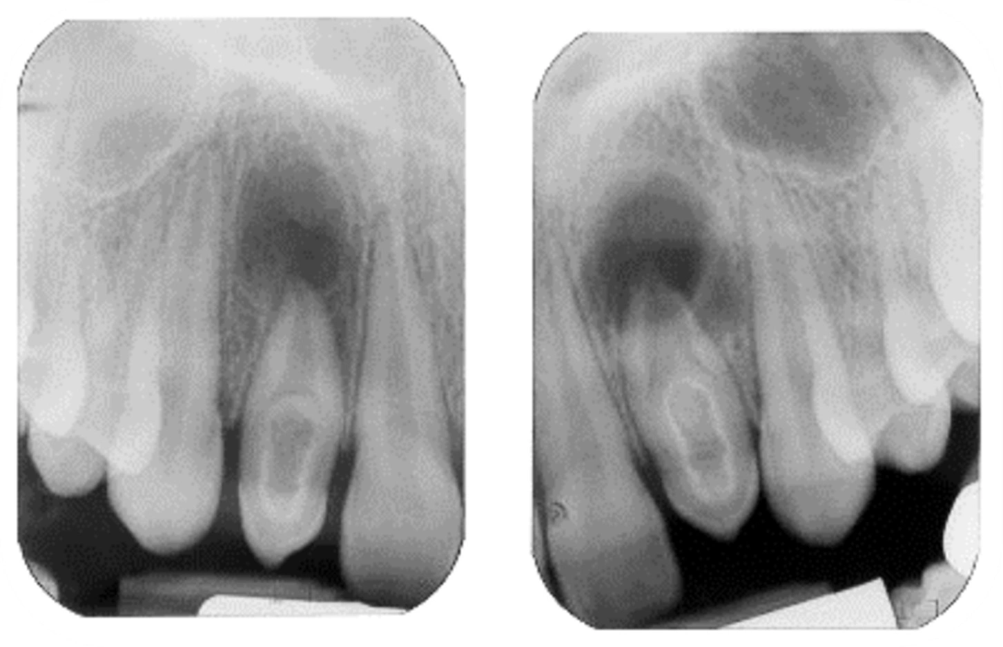 ce589 figure33
Periapical radiograph of tooth #10 with dens invaginatus Type II