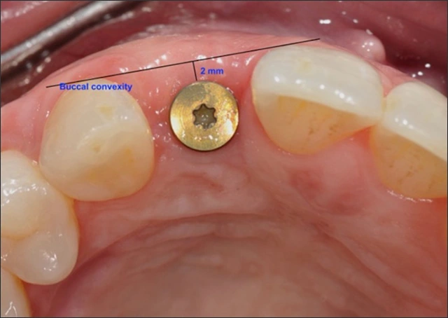 Evaluation of an Edentulous Site - Alveolar Ridge Preservation and ...