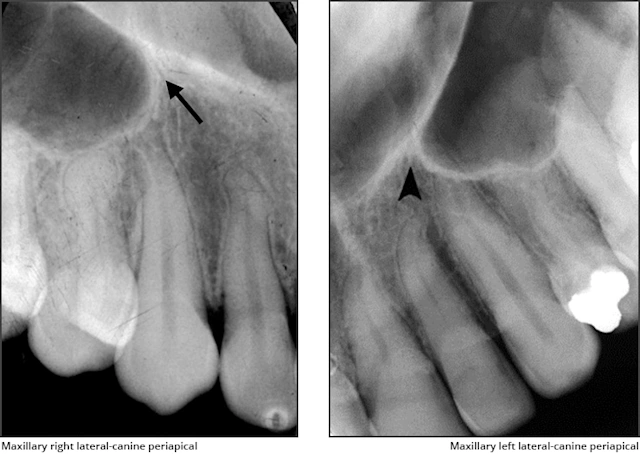 Maxillary Anterior Landmarks - Intraoral Radiographic Anatomy - Dentalcare