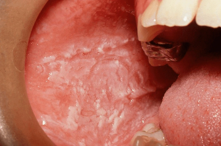 Select Diagnosis White Plaques on the Cheeks