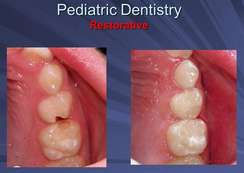 These two images depict that lesions were prepared with Er:YAG laser without anesthesia and that teeth were restored with Glass Ionomer restoration.