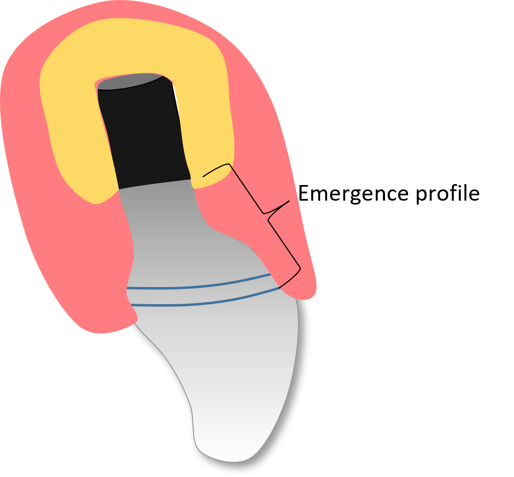 Emergence Profile | Biologically Contoured Esthetic Implant ...