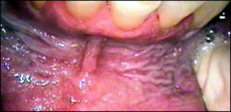 Photo showing leukoplakia at chewing tobacco site.