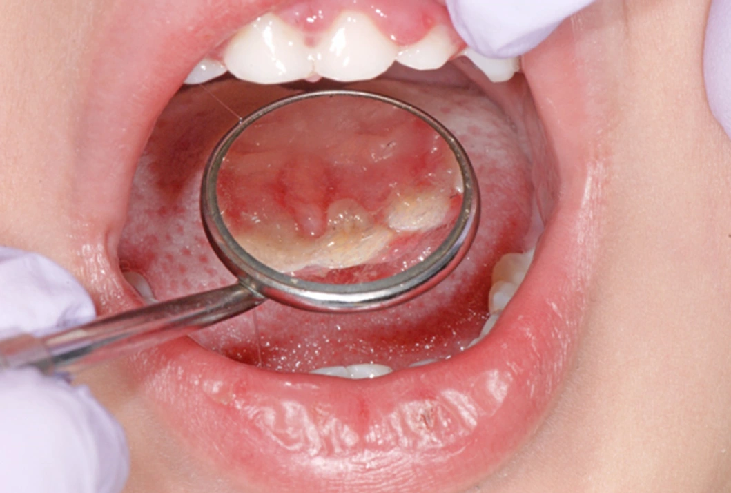 Image 1: Primary Herpetic Gingivostomatitis