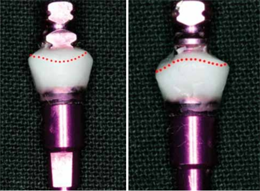 Clinical Workflow For Fabricating Biologically Contoured Restorations ...