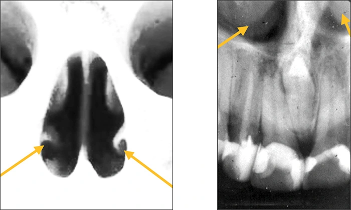 Maxillary Anterior Landmarks - Figure 4