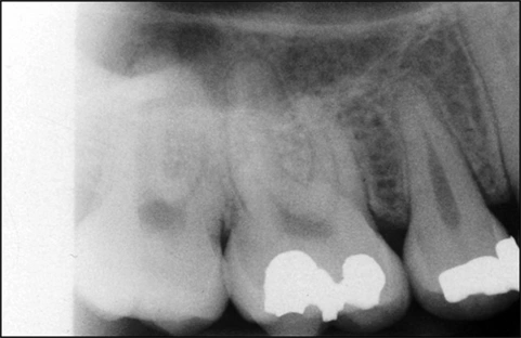 radiograph of rectangular cone cut