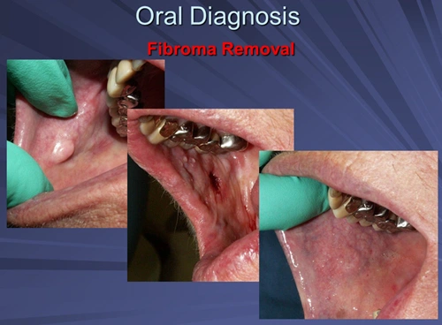 This image depicts Er:YAG laser excisional biopsy of a fibroma on the buccal mucosa.