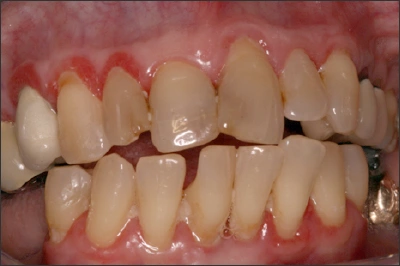 Photo showing an example of periodontal disease