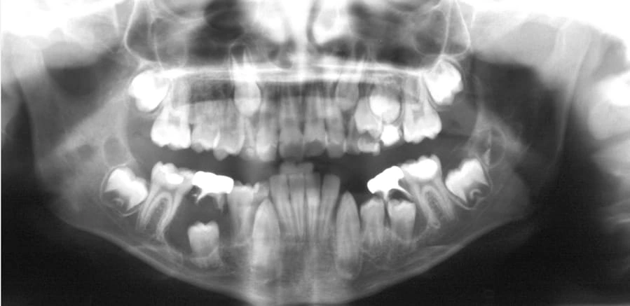 Figure 3. Panoramic Image of a Dentigerous Cyst.