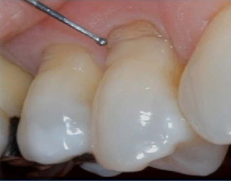 Photo showing the presence of NCCL lesions suggesting the likelihood of improper brushing habits.
