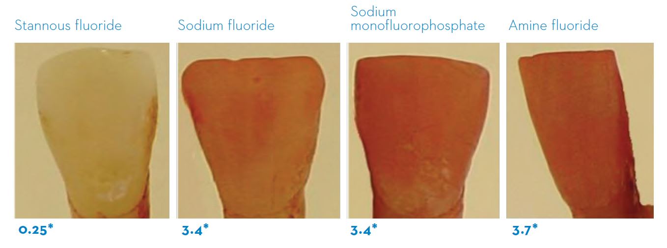 stannous fluoride and sodium fluoride