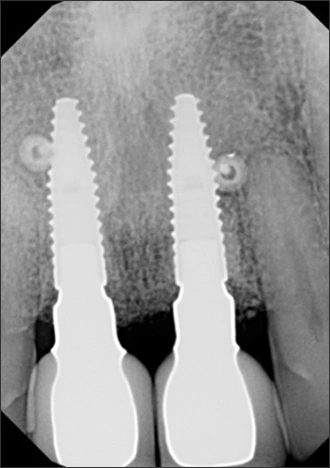 Evaluation of an Edentulous Site - Figure 1