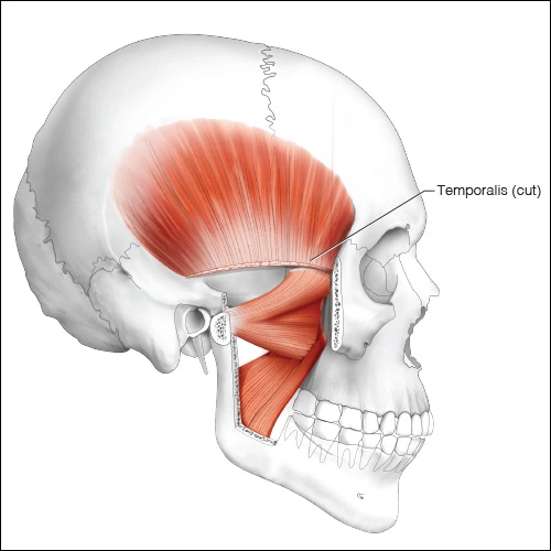 Illustration showing the temporalis (cut) muscle