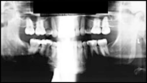 ce589 - Content - Features of an Ideal Panoramic Radiograph - Figure 4