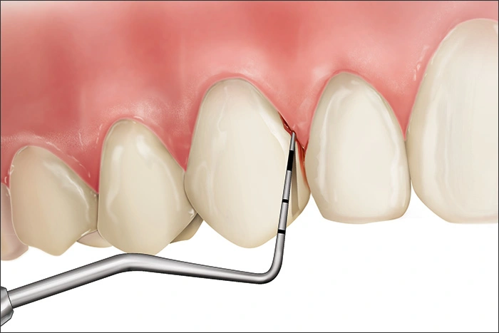 Illustration showing a Code 1 during periodontal probing
