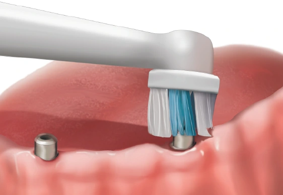 Patient Material - Chăm sóc Trụ cấy Implant Tại Nhà - Dental implants - home care - Vietnamese - Image 5