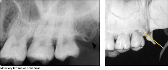 Maxillary Posterior Landmarks - Intraoral Radiographic Anatomy - Dentalcare