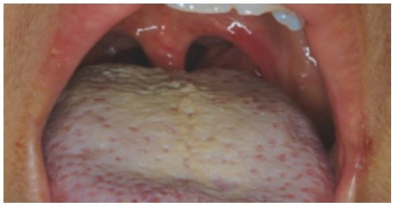 Coating on tongue and heavy bacterial load