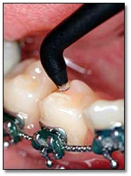 Photo showing the DIAGNOdent being used on a tooth