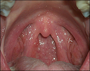 asymmetrical tonsils