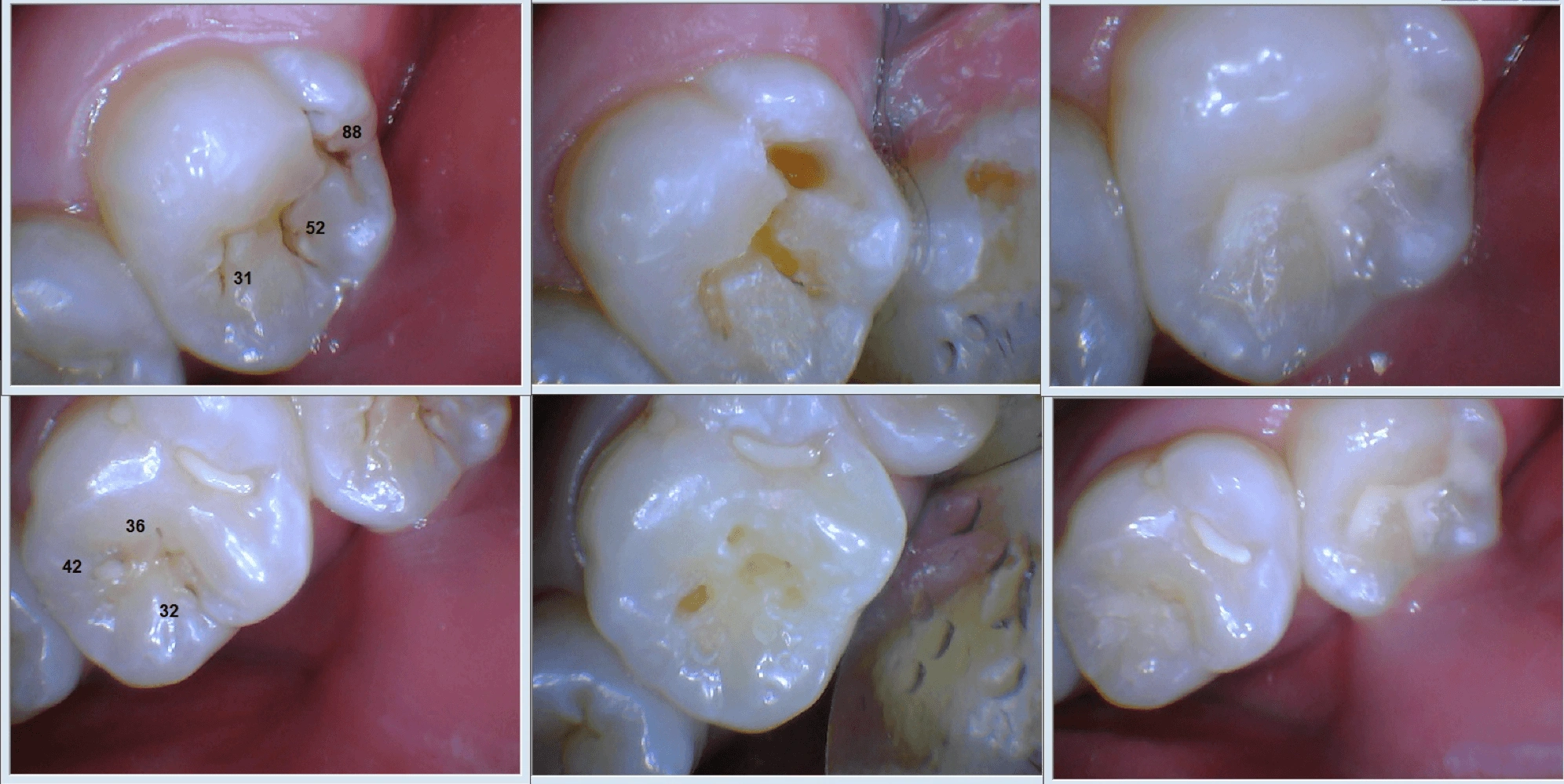 The Diagnodent helps guide the clinician regarding the location and depth of the lesions.