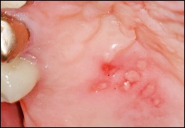 Image: Recurrent Herpetic Lesion