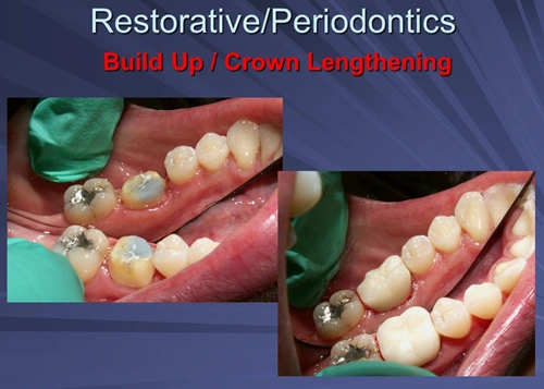 This image depicts the permanent crown is delivered four weeks after the crown lengthening procedure.