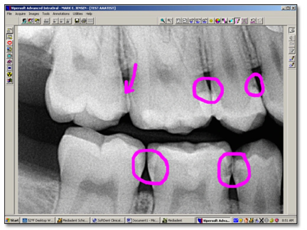 Software showing a digital bitewing radiograph with highlighted areas marked during a discussion with the patient
