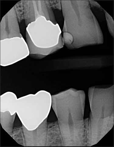 radiograph showing thin enamel and bone resportion