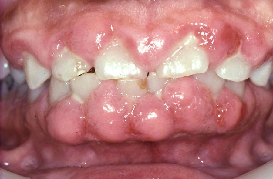  ce536 - Content - ADRs Affecting Oral Tissues - Figure 9