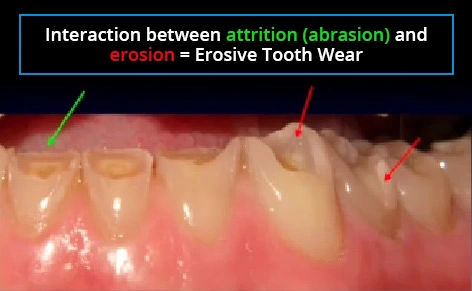 Photo showing high level of ETW on the dentin surfaces, yet leaves some areas of enamel less affected.