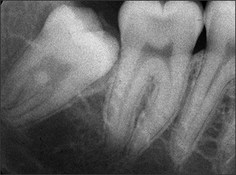Periapical radiograph of #32 with a furcal enamel pearl