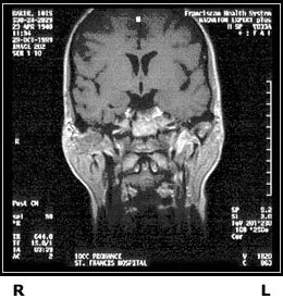 Back view MRI of patient's head